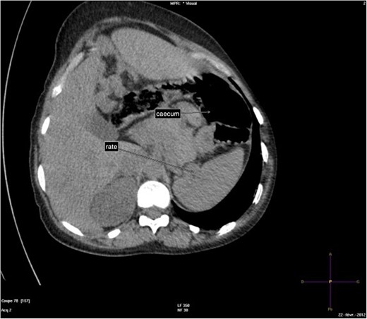 Abdominal-Pelvic CT-scan, non-contrast enhanced, in the sagittal plan, tenth dorsal vertebra level.