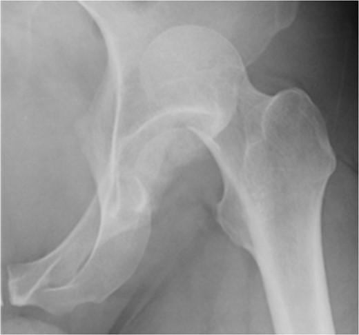 AP radiograph of left hip showing fracture–dislocation of femoral head.