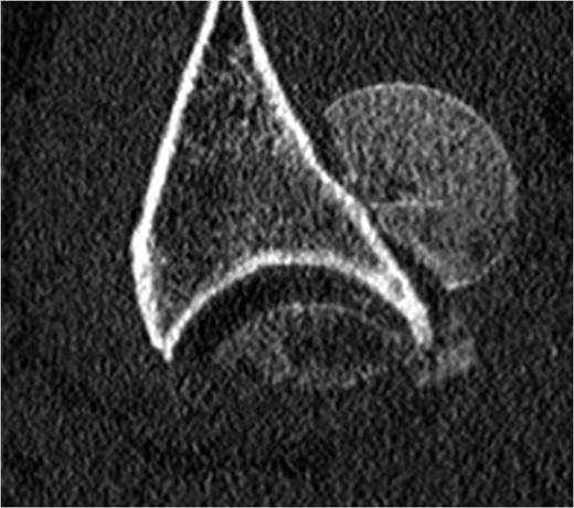 CT image showing fracture–dislocation.