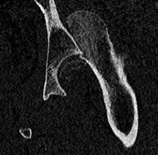 CT image showing fracture–dislocation.