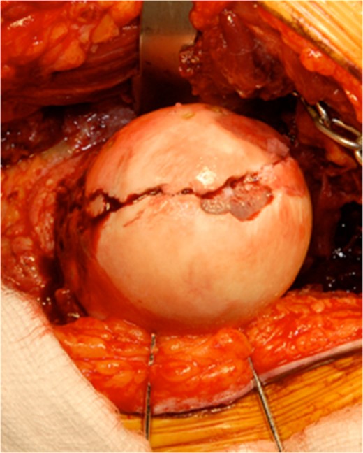 Intraoperative view of the femoral head with temporary fixation with wires.
