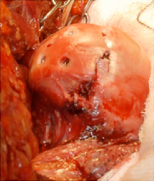 Intraoperative view of the femoral head after fixation with headless compression screws.