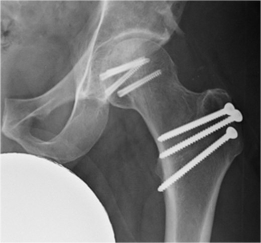 AP postoperative radiograph at 14 months.