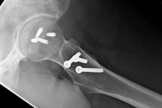 Lateral postoperative radiograph at 14 months.