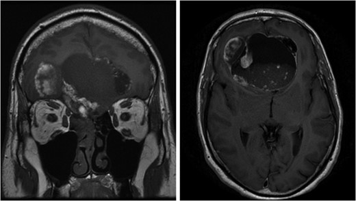 Left image: Coronal pre-operative T1 weighted MRI scan showing extension of the lesion from right nasal cavity to frontal lobe. Right image: Axial pre-operative T1 weighted MRI scan with contrast demonstrates the cystic compartment and mass effect of the lesion.