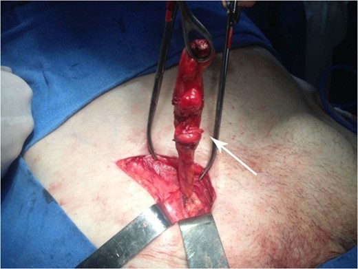 The FH sac (white arrow) can be observed.