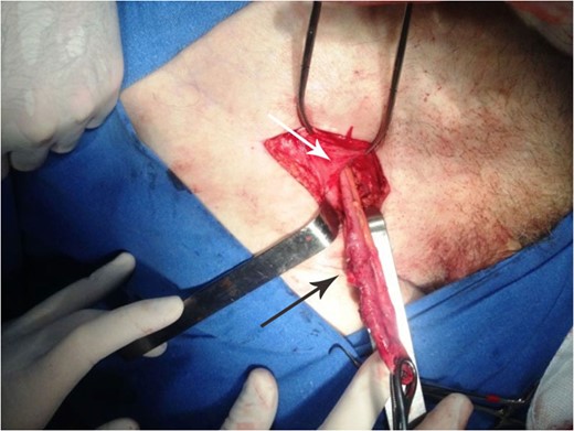 Shows a vermiform appendix (black arrow) within the femoral ring (white arrow).