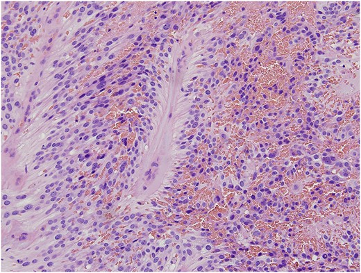 Classic morphologic features of ependymoma including moderately cellular neoplasm composed of cells with mildly pleomorphic round and oval nuclei in a fibrillary background. The neoplastic cells arranged as solid sheets and cords of cells with occasional cribriform pattern. The eosinophilic cellular processes extended around blood vessels with formation of perivascular pseudorosettes. Areas of myxoid degeneration, necrosis and hemosiderin deposition was evident.