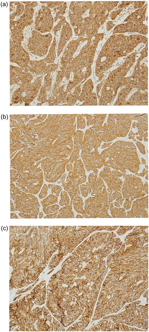 Immunohistochemical analysis demonstrated diffuse and strong expression of CD99 (a), GFAP (glial fibrillary acidic protein) (b), and CD56 (c) in the neoplastic cells. They were negative for cytokeratin (AE1/AE3) which confirmed the morphologic diagnosis of ependymoma.