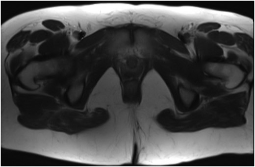 MR of the pelvis showing no evidence of persistent or recurrent sacrococcygeal ependymoma.