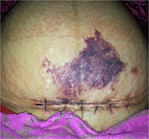 Patient at the time of presentation on sixth post-operative day.