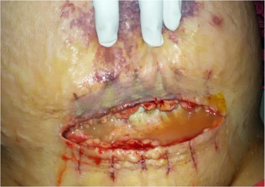 Wound at the time of debridement.