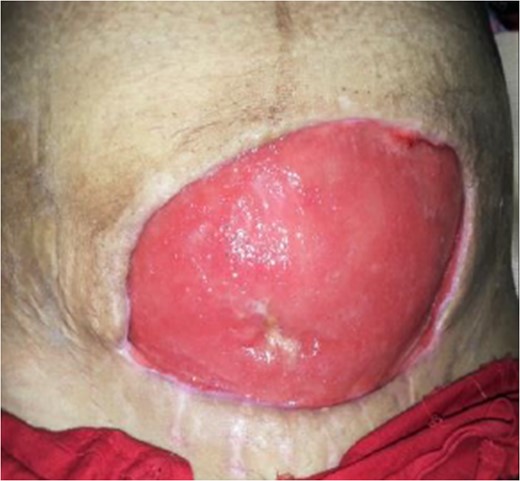 Post-debridement.