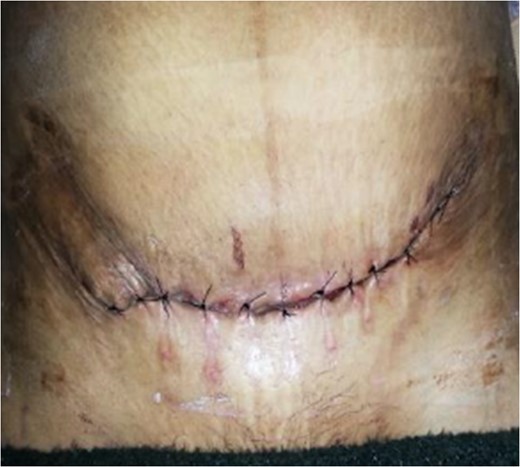 At the time of discharge after delayed re-suturing.