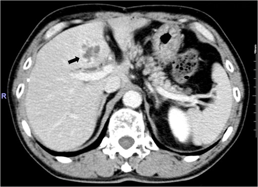 Abdominal enhanced computed tomography image showing an irregular ring-enhanced lesion in Segment 4 of the liver.