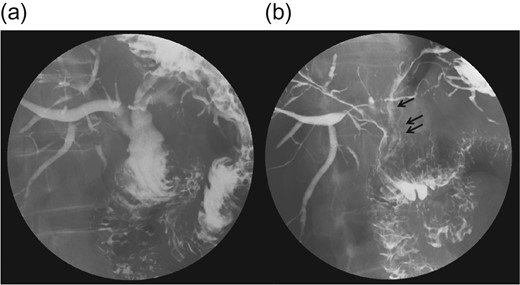 (a) A gastrografin study with the patient in a standing position shows influx of gastrografin to the bile duct. (b) A study with the patient in a supine position shows food debris in the bile duct. The stricture at the anastomosis was not visible.