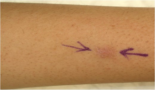 Small forearm discolored swelling.