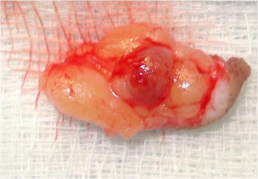 Glomus tumor after excision.