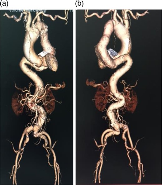 Preoperative contrast CT 3D image. (a) Anterior view, (b) Posterior view. A severe angulation was observed in the distal site of the thoracic descending aorta. Many angulations were also found in the peripheral vasculature.
