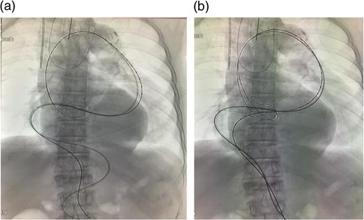 (a) A sheath was introduced and the angulation was slightly reduced. (b) A guide wire was introduced through the sheath. The angulation was further reduced by this procedure. In addition, the angulation of the wire (black arrow), which was used to introduce the stent graft main body, was reduced. Thus, the wire was advanced through the aorta where angulation was small.