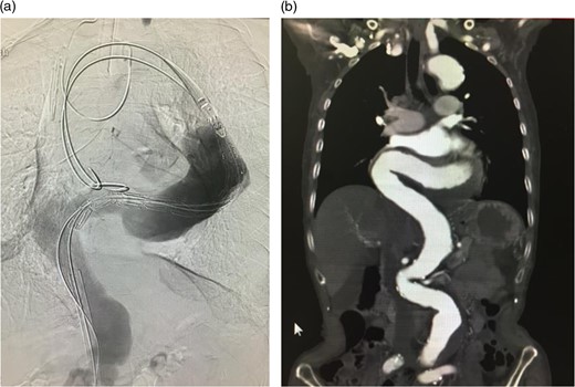Intraoperative arteriogram. (a) The hard sheath was left at the distal site of the angulated part and the flexible sheath was advanced. The angulation was sufficiently reduced by additionally introducing delivery devices for the stent graft (sheath and guide wire). Thus, the stent graft was introduced to the proximal side of the angulated part beyond the aneurysm. Compared to the preoperative contrast CT coronal section image (b) a reduction in the angulation of the proximal aneurysm was observed.