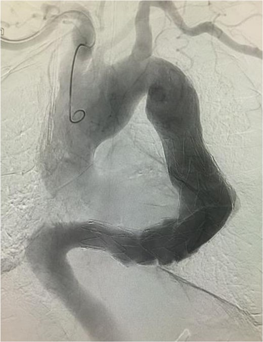 Angiographic image at the completion of treatment. No endoleak was observed. There was no contrast enhancement in the location of the aneurysm.