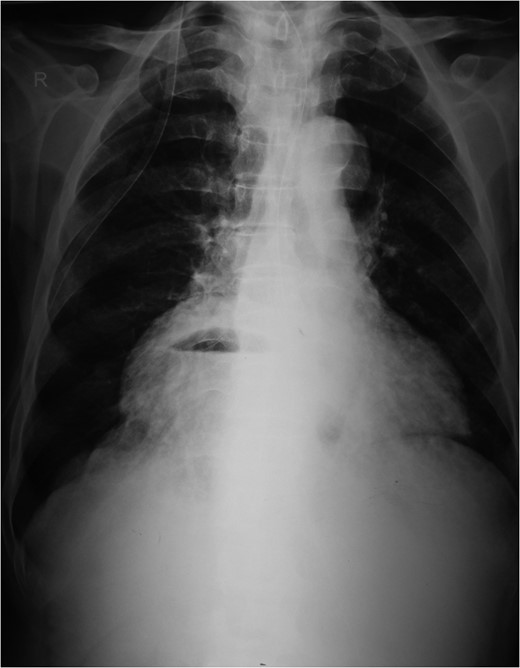 Preoperative chest X-ray.