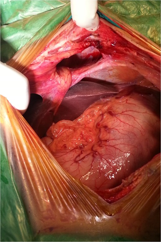 Intraoperative findings.