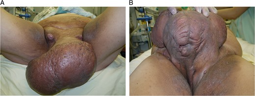 (A and B) Pre-surgical view of the genital area on the table.