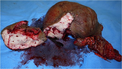 The resected specimen and cross-section. It measured 25 × 30 × 20 cm and weighed 3.6 kg.