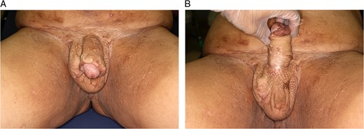 (A and B) One year after the surgery.