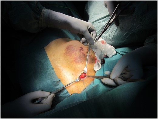 Perioperative image showing the location of the pseudoaneurysm, upper medial quadrant of the right breast and the healing hematoma of the right breast.