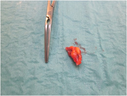 The pseudoaneurysm perioperatively after surgical removal.