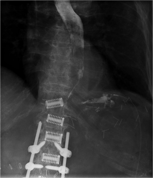 Fluoroscopic image demonstrating contrast entering intraperitoneal drain in proximity to gastric perforation (previous spinal surgery).