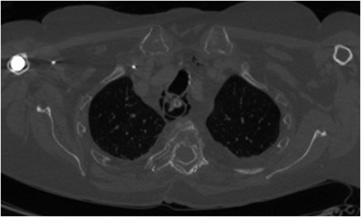 Axial CT scan (bone window) demonstrating mediastinal emphysema as a result of iatrogenic cervical oesophageal perforation.