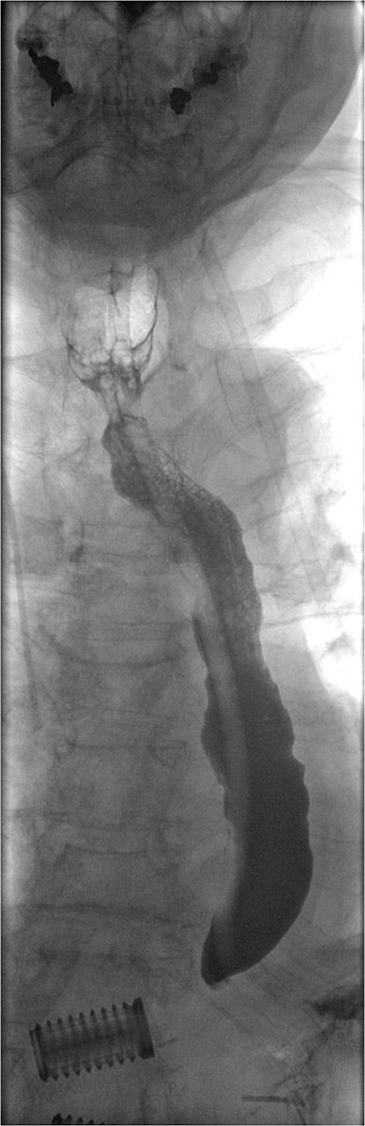 Water-soluble contrast swallow study demonstrating free flow of contrast from oropharynx to stomach with no evidence of leak.