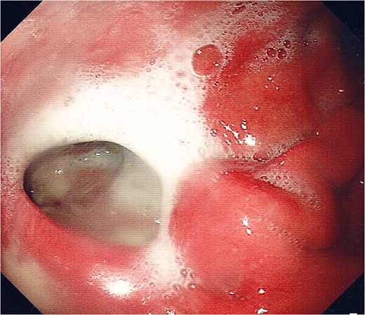 Endoscopic photograph showing perforation of the posterior gastric wall with established cavity.