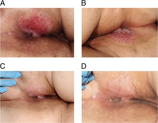 (A) Initial presentation with an erythematous perianal lesion with associated superficial excoriation. (B) Appearance of rash following 5 weeks and (C) 16 weeks of treatment with 5% imiquimod cream, demonstrating stepwise improvement. (D) Appearance of perineum at 6-month follow-up following completion of treatment.