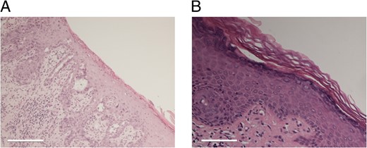 (A) Initial punch biopsy of the perianal lesion demonstrated a well-demarcated erosive lesion with associated fibrin deposition and acute inflammation. (B) Following the 16-week course of imiquimod cream, repeat biopsies demonstrated chronic inflammation with epidermal reaction and prominent vascular proliferation, but no evidence of EMPD. Both produced with haematoxylin & eosin staining. Scale bar 500 μm (A) and 200 μm (B).