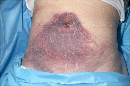 Clinical photography of peri-umbilical ecchymosis.