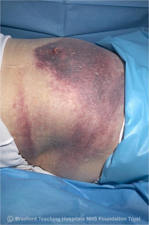 Clinical photography of peri-umbilical ecchymosis.