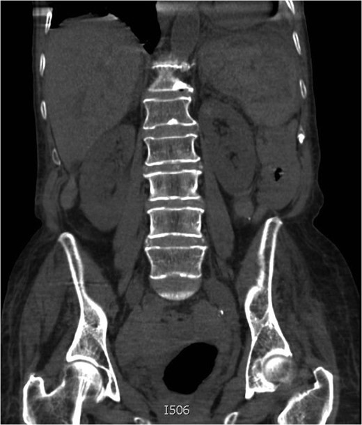 Coronal image from CT with IV contrast.