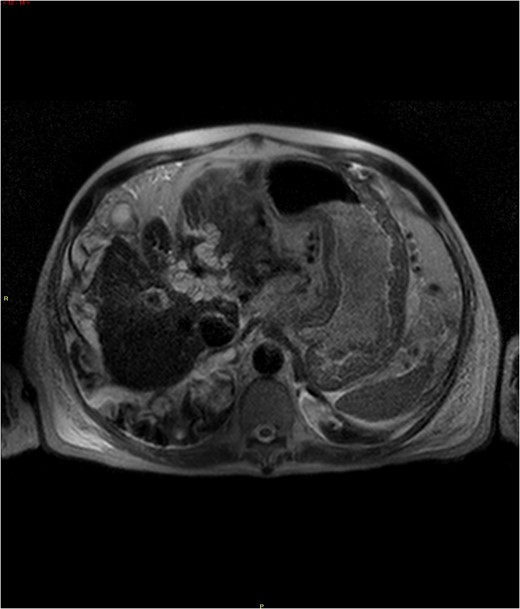 MRI abdomen demonstrating increased T2 signal intensities along the left bile ducts and to lesser extent the right bile ducts.