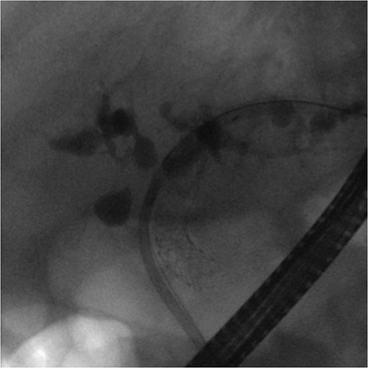 ERCP demonstrating mild-to-moderate intrahepatic ductal dilatation with multifocal biliary strictures.