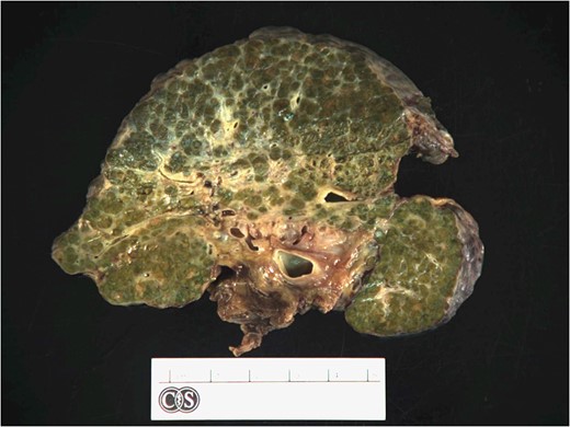 The liver was grossly cirrhotic with an ill-defined lesion consisting of multiple variably sized cystic spaces in the hilar area that did not communicate with the bile ducts.