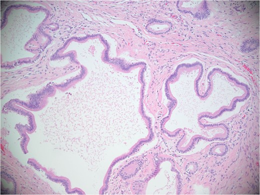 Microscopic image. Sections of the cystic spaces showed variably sized cystic structures predominately lined by simple cuboidal to columnar biliary-type epithelium.