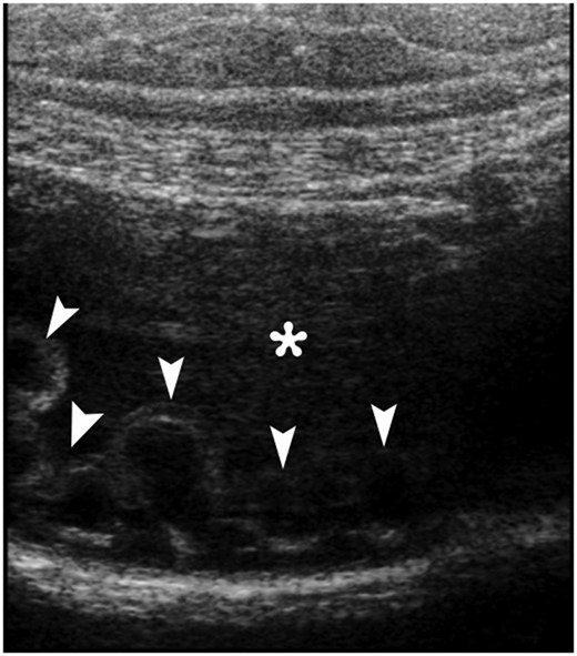 An abdominal gray-scale ultrasound image obtained with a linear transducer clearly depicts multiple anechoic cystic nodularities (arrowheads) in the intestinal wall protruding the fluid-filled lumen (*).