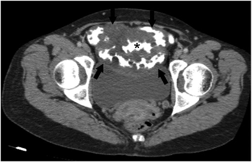 An axial CT image obtained with intravenous and oral contrast material shows abnormal wall thickening of ileal loops (arrows). Please note that the multiple nodular formations of ileal wall protruding the contrast-filled intestinal lumen (*). Abdominal CT scan also demonstrates a mass-like diffuse expansion of mesenteric root with low attenuation (arrows).