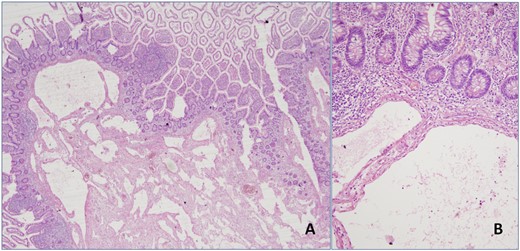 (A) Expanded cystic vascular lesion focally extending to the intestinal mucosa is seen (H&E, 4× magnification). (B) High power view of the lesion (H&E, 20× magnification).