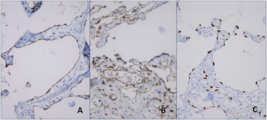 Immunohistochemically the endothelial cells, lining the vascular structures, were reactive with D2-40 (A), CD31 (B) and ERG (C).